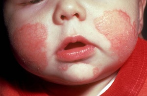 Eczema ở trẻ em đang gia tăng.