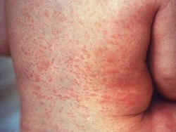 Điều trị sốt phát ban dạng Rubella