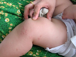 Virus tay chân miệng nguy hiểm lan tràn ở Quảng Ngãi