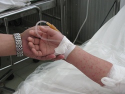 Bàn tay nổi nhiều nốt đỏ của một bệnh nhi tay chân miệng bị biến chứng. Ảnh: Cao Lâm.
