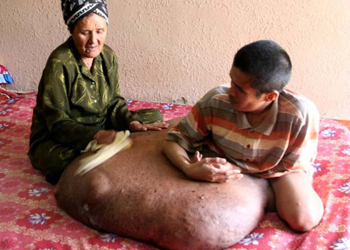 Nguyễn Duy Hải chỉ có thể ngồi với khối u khổng lồ trên chân, mọi sinh hoạt đều phải nhờ mẹ già giúp đỡ. Ảnh: Quốc Dũng
