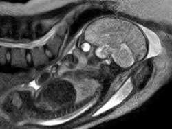 Máy MRI kiểu mới giúp các bác sĩ quan sát chi iết và giải thích được nguyên hân khó inh của thai pụ - Nguồn Foxnews