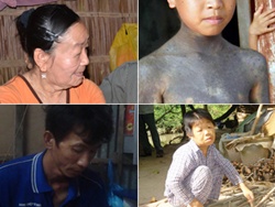 Những người mắc bệnh kỳ lạ nhất Việt Nam